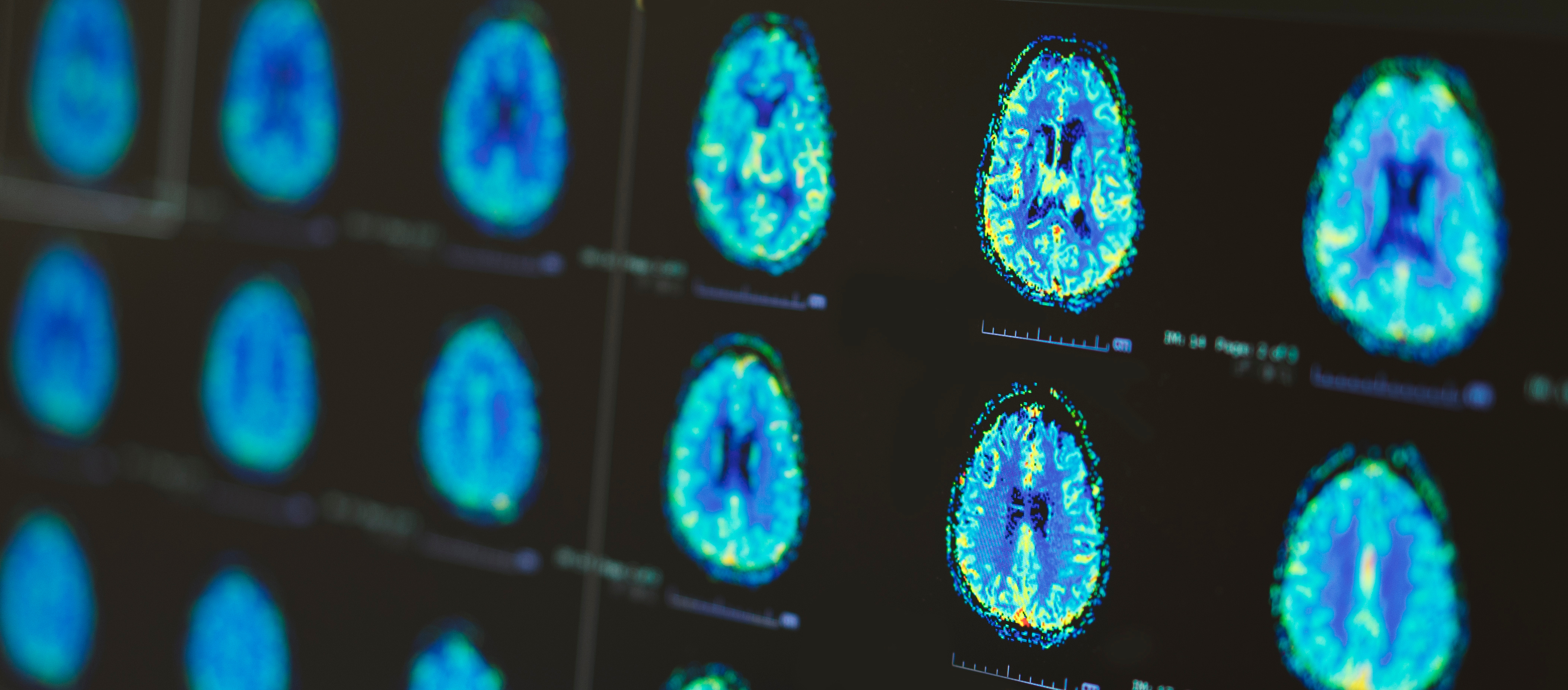 White matter application